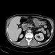 Colorectal cancer, carcinoma of transverse colon, lymphadenopathy, liver metastases: CT - Computed tomography